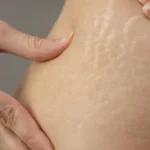 Mengatasi Stretch Mark pada Remaja: Tips dan Trik untuk Kulit Sehat