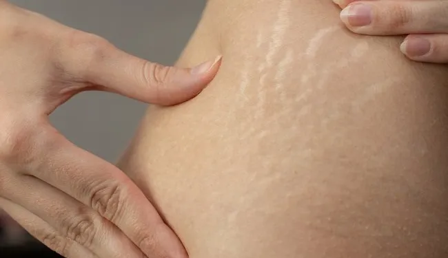 Mengatasi Stretch Mark pada Remaja: Tips dan Trik untuk Kulit Sehat