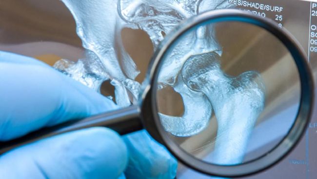 Faktor Genetik Turut Picu Asam Urat, Bukan Hanya Karena Pola Makan