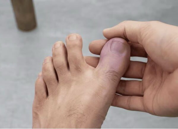 Jempol Kaki Kebas Jangan Dianggap Sepele, Kenali 6 Penyebab dan Cara Mengatasinya
