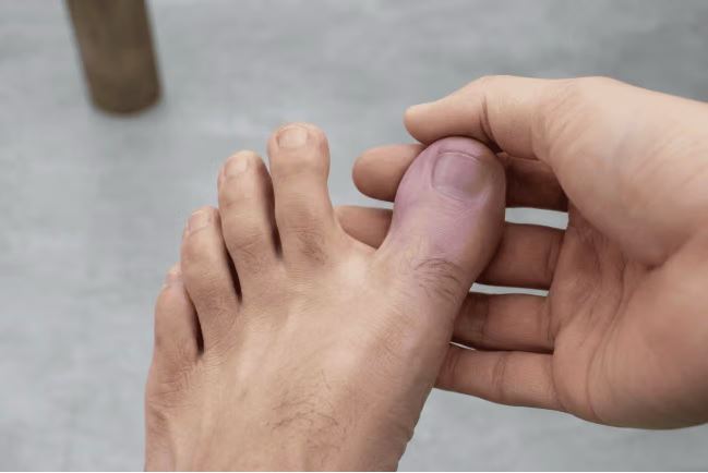 Jempol Kaki Kebas Jangan Dianggap Sepele, Kenali 6 Penyebab dan Cara Mengatasinya